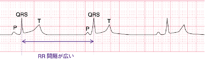 徐脈の心電図