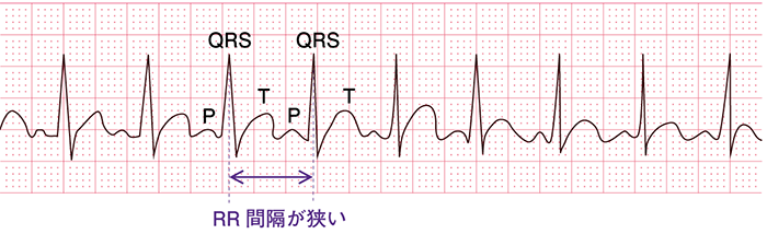 頻脈の心電図