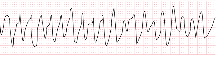 心室細動の心電図
