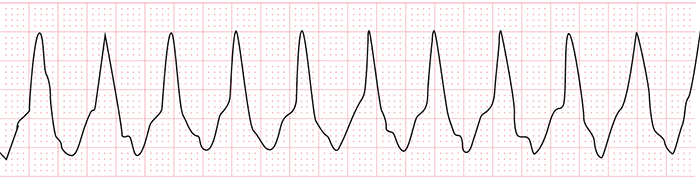 心室頻拍の心電図