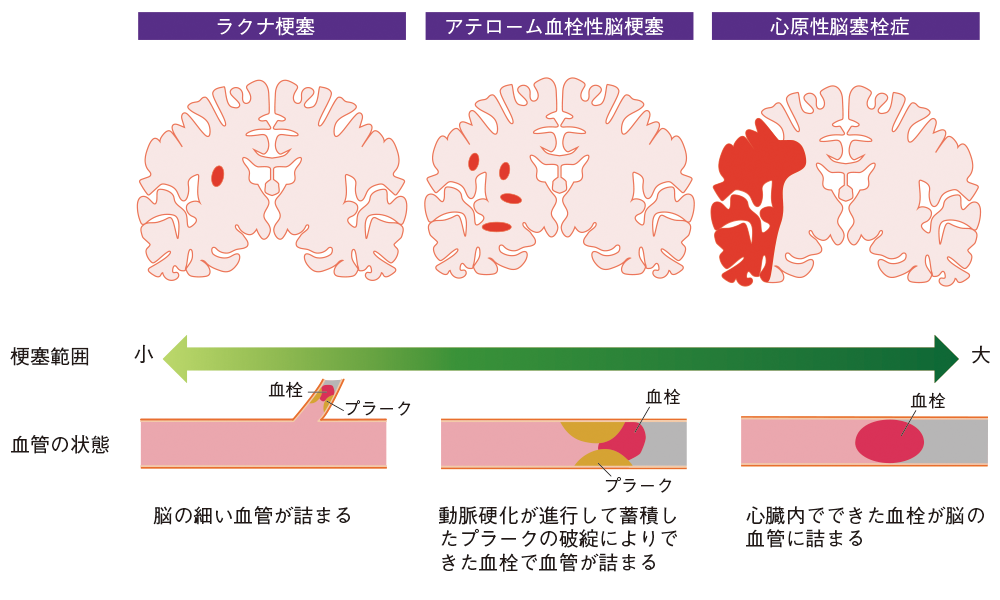 脳梗塞の分類と特徴