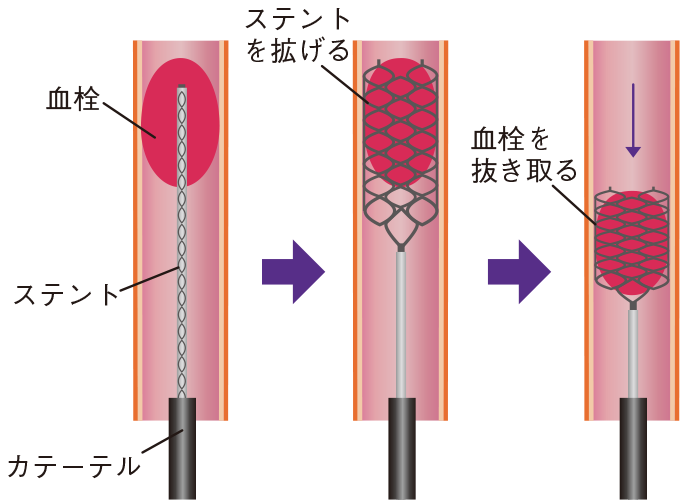 ステントによる血栓回収療法