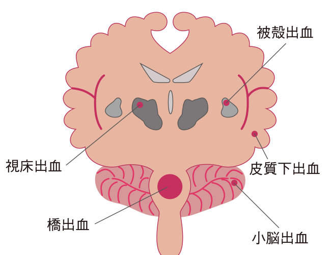 脳出血の障害部位