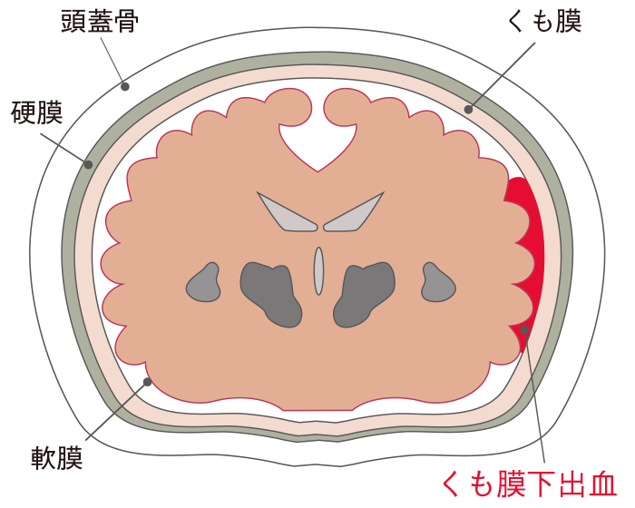 くも膜下出血