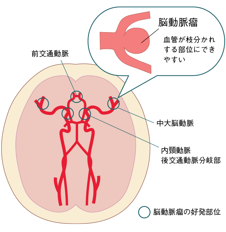 くも膜下出血が起こりやすい場所