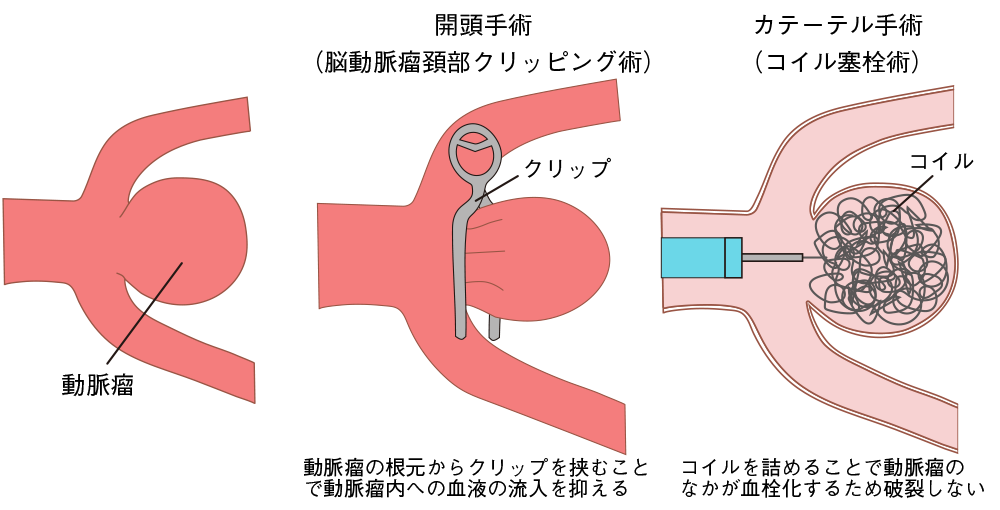 くも膜下出血の急性期治療