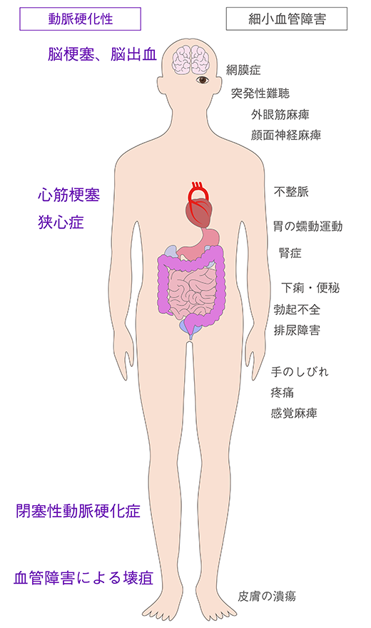 糖尿病の合併症