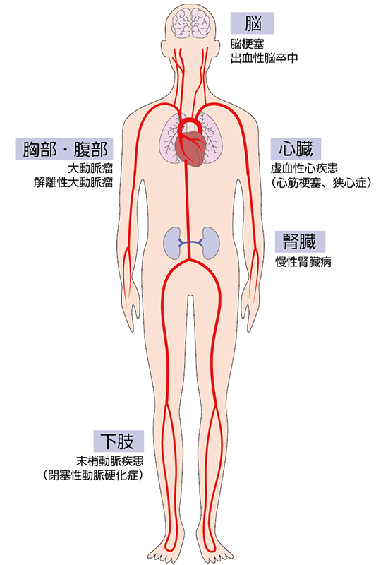 主な動脈硬化性疾患