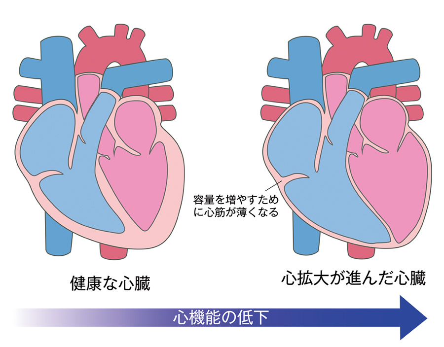 心臓リモデリング