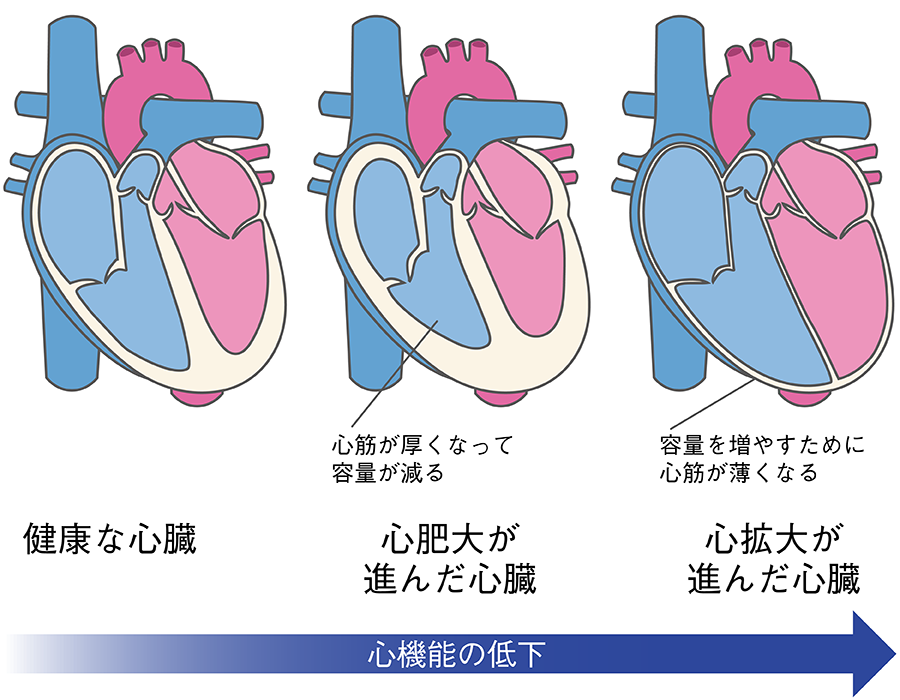 心臓リモデリング