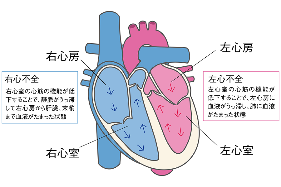 左心不全と右心不全