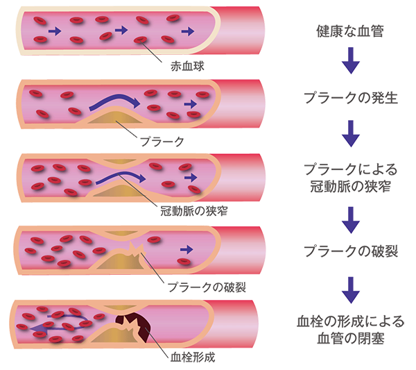 動脈硬化と血管の閉塞