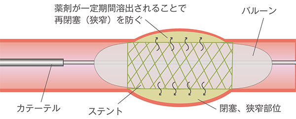 薬剤溶出性ステントのしくみ