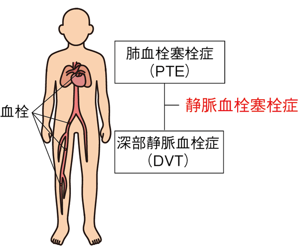 静脈血栓塞栓症