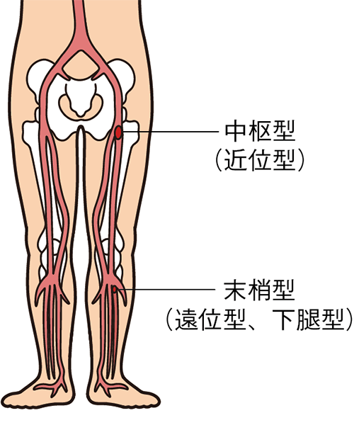 深部静脈血栓症の分類